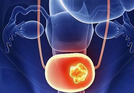 کاهش عفونتهای جنسی در دوران شیوع کرونا