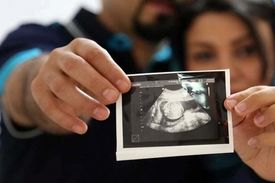 توضیحات وزارت بهداشت درباره ساماندهی غربالگری سندروم داون
