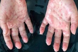 بهبودی بیمار مبتلا به آبله‌ میمونی در ایران