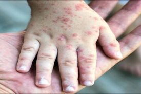 جان باختن بیش از ۲۰ تن در پی ابتلا به سرخک در افغانستان